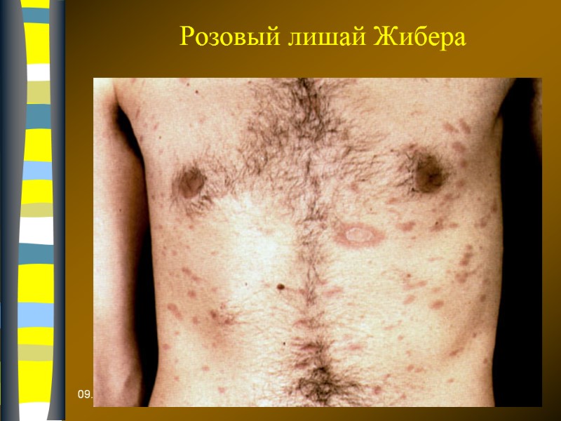 09.12.2017 Розовый лишай Жибера